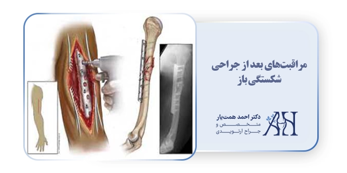 مراقبت‌های بعد از جراحی شکستگی باز