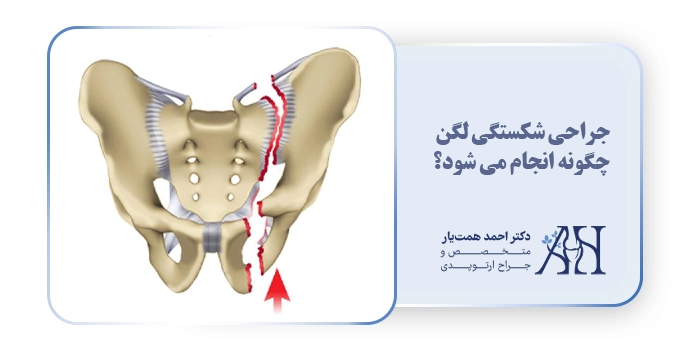 جراحی شکستگی لگن چگونه انجام می شود؟