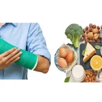 تغذیه بعد از شکستگی استخوان