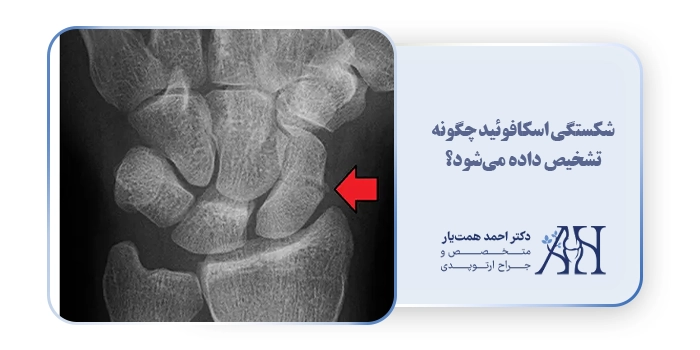 شکستگی اسکافوئید چگونه تشخیص داده می‌شود؟