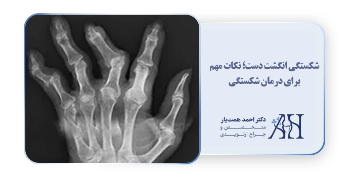 شکستگی انگشت دست؛ نکات مهم برای درمان شکستگی