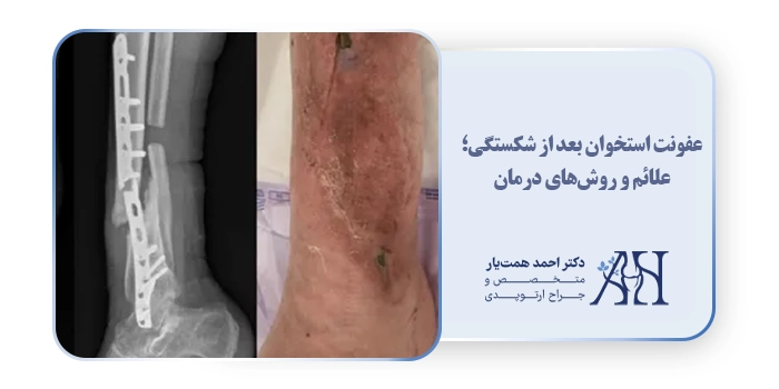 عفونت استخوان بعد از شکستگی؛ علائم و روش‌های درمان
