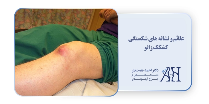 علائم و نشانه های شکستگی کشکک زانو