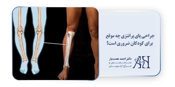جراحی پای پرانتزی چه موقع برای کودکان ضروری است؟