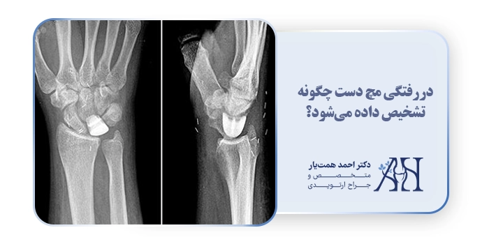 دررفتگی مچ دست چگونه تشخیص داده می‌شود؟