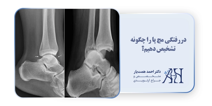 دررفتگی مچ پا را چگونه تشخیص دهیم؟