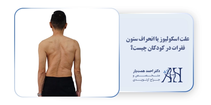 علت اسکولیوز یا انحراف ستون فقرات در کودکان چیست؟