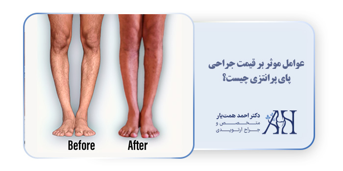 عوامل موثر بر قیمت جراحی پای پرانتزی چیست؟