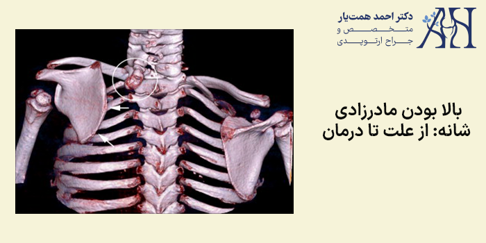 بالا بودن مادرزادی شانه: از علت تا درمان
