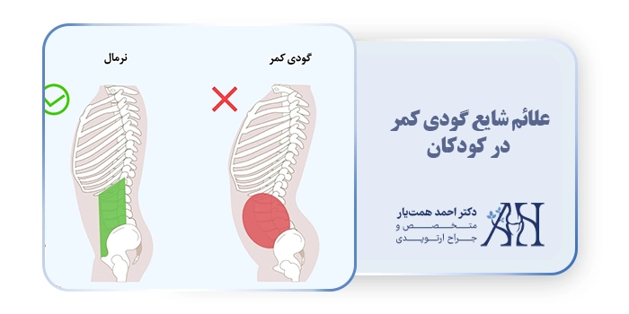 علائم شایع گودی کمر در کودکان